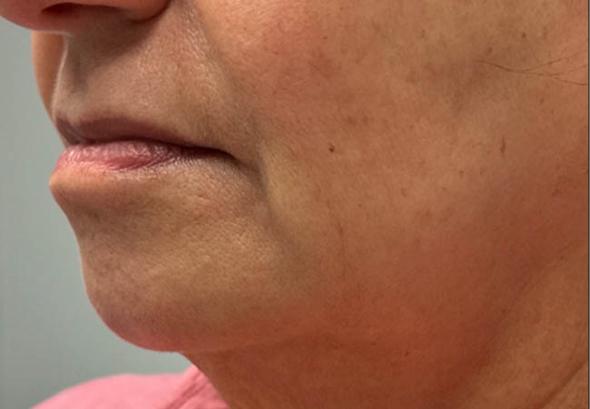 1_0007_Patient 10 after chin filler.PNG