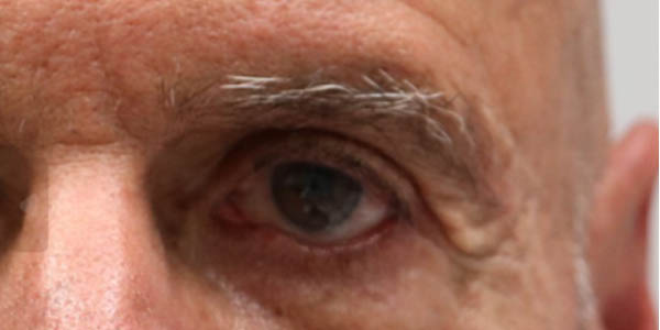 1_0007_patient 4 before revision surgery by canthoplasty and full thickness skin graft.png