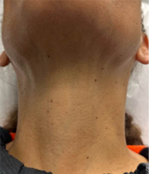 1_0007_patient 6 before IPL.png
