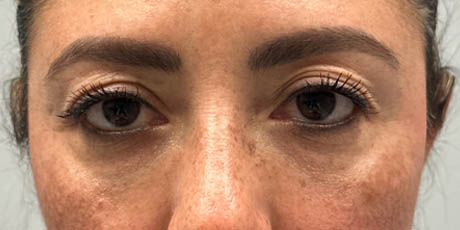 1_0007_patient 88 before upper bleph with subbrow filler.png