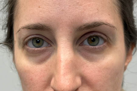 1_0008_PATIENT 301 AFTER SUBBROW FILLER.png