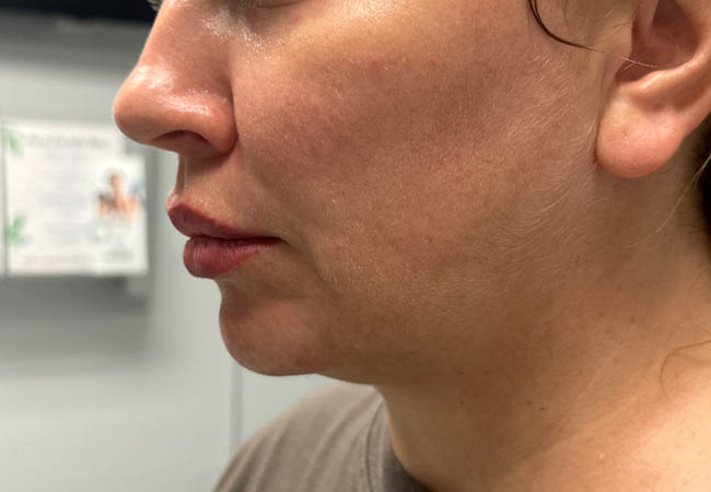 1_0008_Patient 11 before chin and jawline (side).PNG