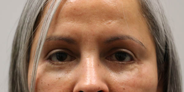 1_0008_pt 2 after lower eyelid revision- front.JPG