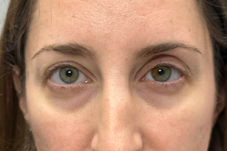 1_0009_PATIENT 301 BEFORE SUBBROW FILLER.png