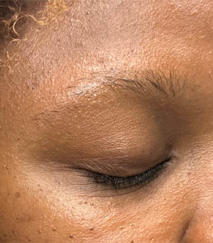 1_0009_patient 13 after chalazia removal– side.png