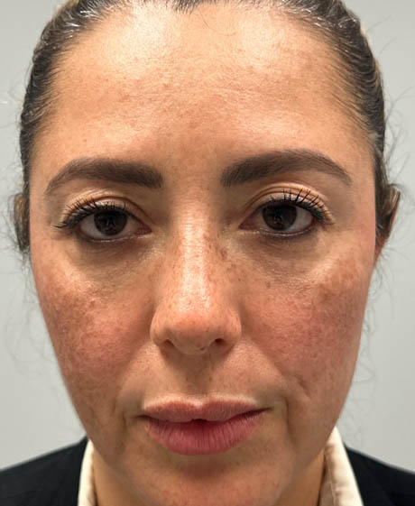 1_0010_patient 10000 before upper bleph with subbrow filler.png
