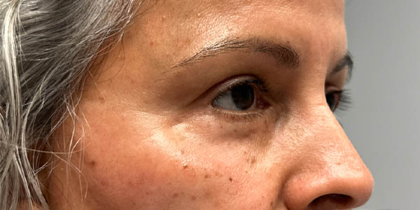 1_0010_pt 2 after lower eyelid revision- right side.png