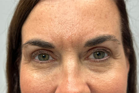 1_0012_PATIENT 303 AFTER SUBBROW FILLER AND UPPER BLEPH.png