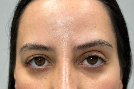 1_0014_PATIENT 304 AFTER SUBBROW FILLER.png