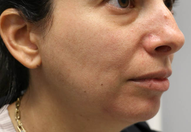 1_0014_patient 12 before chin contouring- right side.png