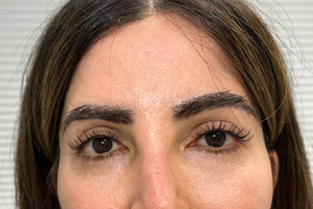 1_0016_PATIENT 305 AFTER SUBBROW FILLER.png
