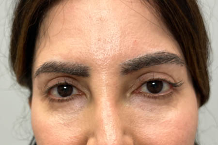 1_0017_PATIENT 305 BEFORE SUBBROW FILLER.png