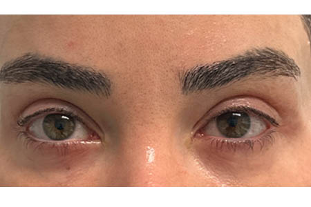 1_0018_patient 306 after subbrow filler.png