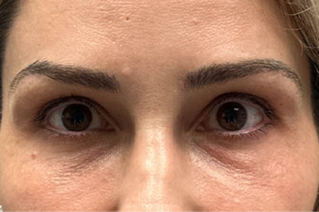 1_0020_patient 307 after subbrow filler.png