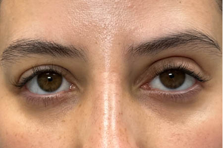 1_0024_patient 311 after subbrow filler.png