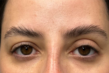 1_0025_patient 311 before subbrow filler.png