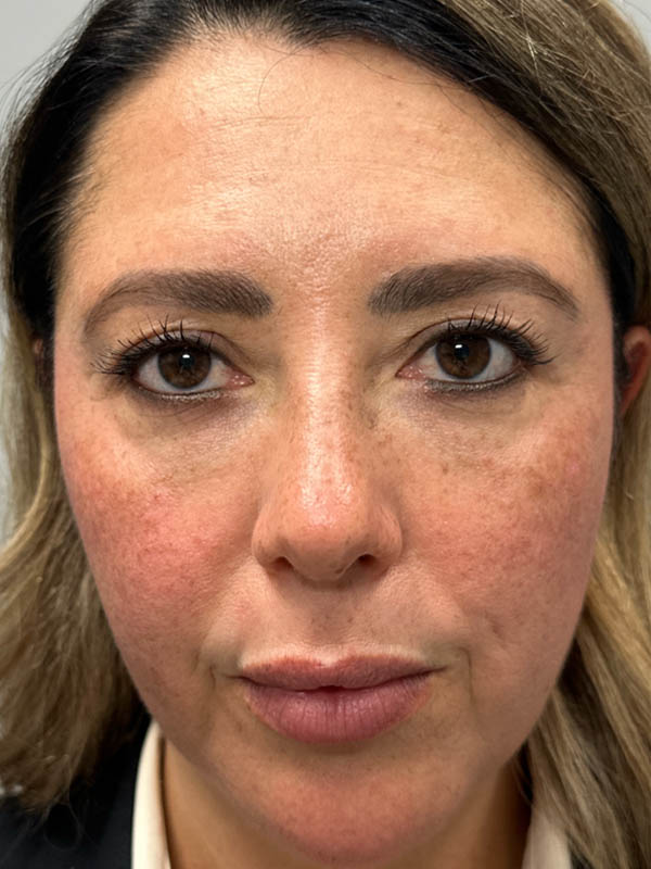 1_0028_patient 88 after upper bleph with subbrow filler.png