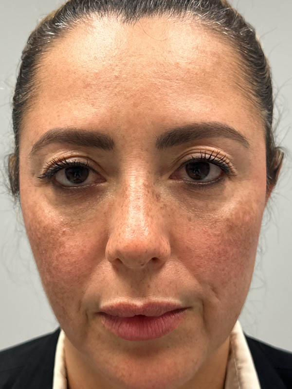 1_0029_patient 88 before upper bleph with subbrow filler.png