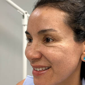 Untitled-25_0003_patient 10 before botox.png copy