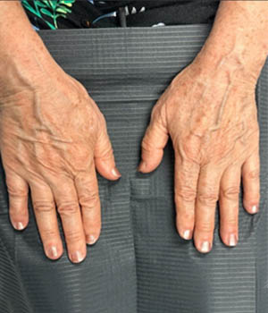 Untitled-26_0000_BY BONNIE patient 56 after IPL.png copy