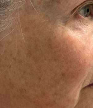 Untitled-26_0002_BY BONNIE patient 57 after IPL left side.png