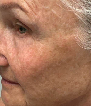 Untitled-26_0003_BY BONNIE patient 57 after IPL.png