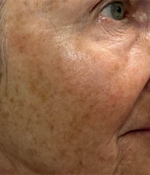 Untitled-26_0004_BY BONNIE patient 57 before IPL left side.png