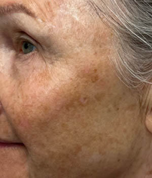 Untitled-26_0005_BY BONNIE patient 57 before IPL.png