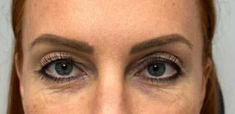 a_0000_patient 40 before upper bleph, ptosis repair and subbrow filler – front.png