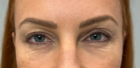 a_0001_patient 40 after upper bleph, ptosis repair and subbrow filler – front.png