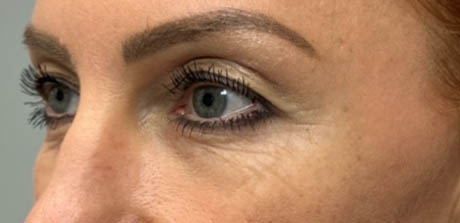 a_0002_patient 40 before upper bleph, ptosis repair and subbrow filler – left side.png