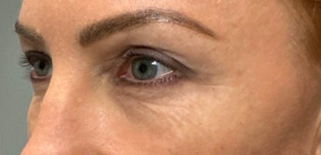 a_0003_patient 40 after upper bleph, ptosis repair and subbrow filler – left side.png