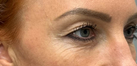 a_0004_patient 40 before upper bleph, ptosis repair and subbrow filler – right side.png