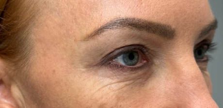 a_0005_patient 40 after upper bleph, ptosis repair and subbrow filler– right side.png