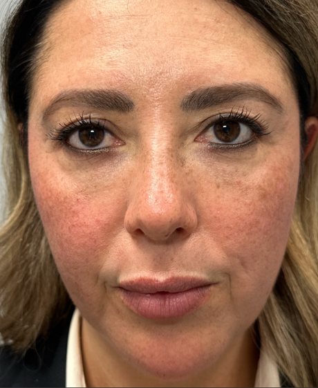 patient 10000 after upper bleph with subbrow filler.png