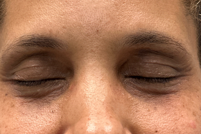 patient 14 after xanthelasma removal