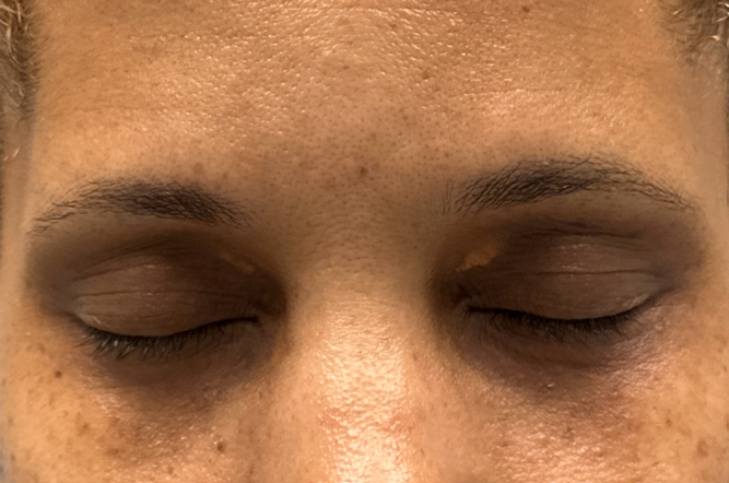 patient 14 before xanthelasma removal