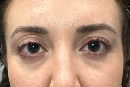 1_0001_patient 35 before upper bleph with sub-brow filler.png