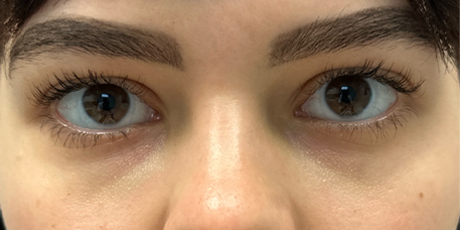 patient 3 after laser vein treatment front.png