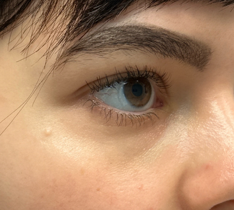 patient 3 after laser vein treatment side.png