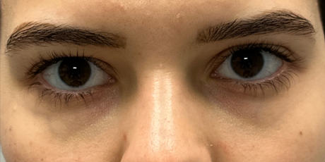 patient 3 before laser vein treatment front.png