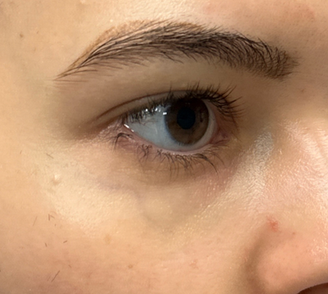 patient 3 before laser vein treatment side.png