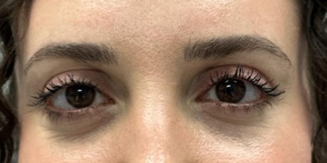 patient 35 after upper bleph with sub-brow filler.png