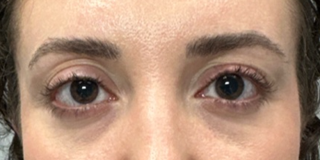 patient 35 before upper bleph with sub-brow filler.png