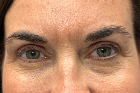 patient 54 after upper bleph with subbrow filler-front.png