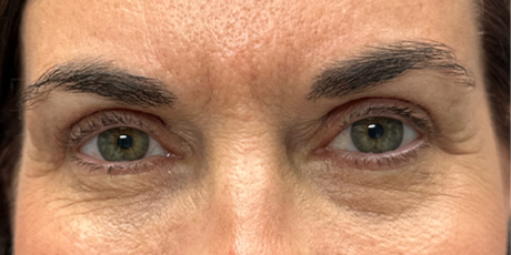patient 54 after upper bleph with subbrow filler-front.png