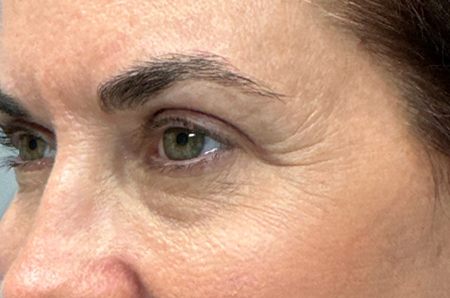 patient 54 after upper bleph with subbrow filler-side.png