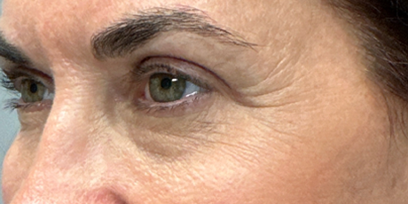 patient 54 after upper bleph with subbrow filler-side.png