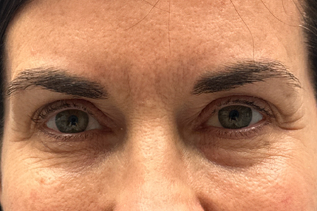 patient 54 before upper bleph with subbrow filler-front.png