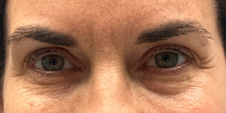 patient 54 before upper bleph with subbrow filler-front.png